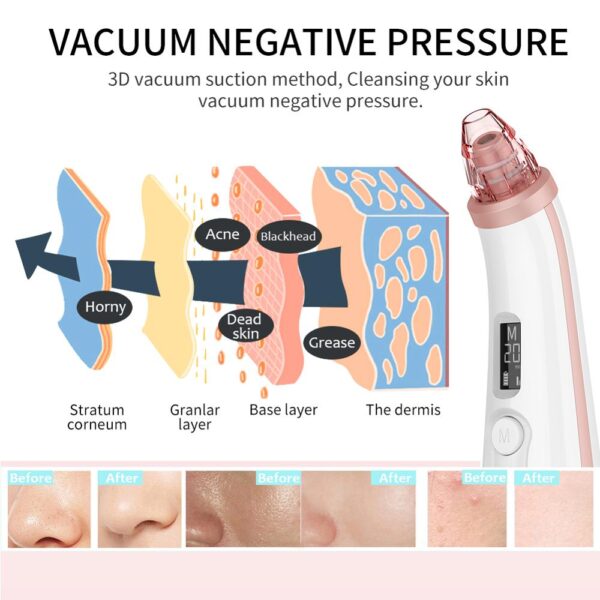 ANLAN Vacuum Blackhead Remover Skin Care Pore Acne Pimple Removal Blackhead Removal Device Vacuum Pore Cleaner For Face